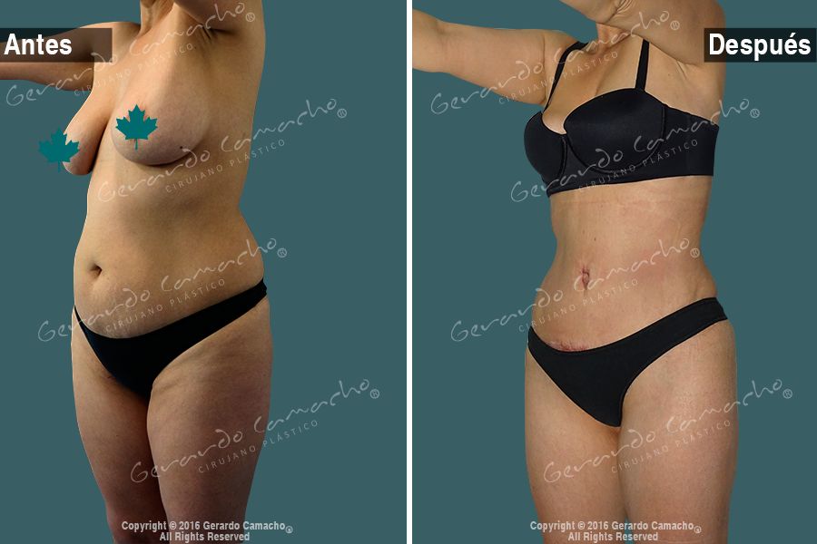 Detalle del abdomen después de abdominoplastia en Bogotá